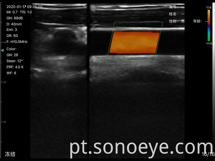 wirelss ultrasound